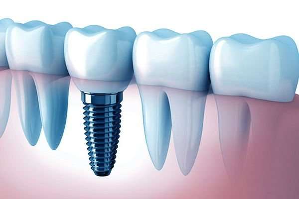 gums diseases enfermedad periodental encias periodontal