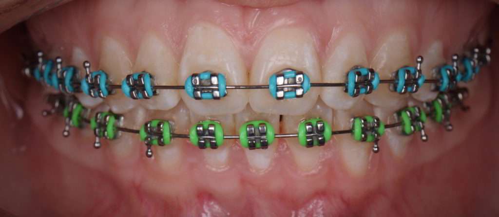 ortodoncia orthodontics