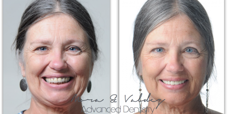 Advanced dentistry, antes y después