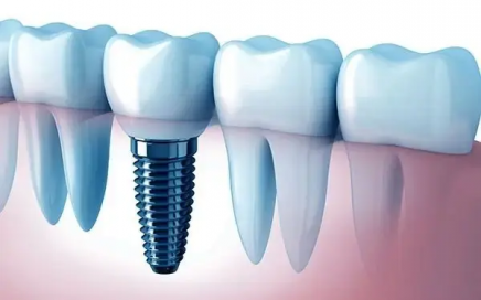 Dental implants advanced dentistry costa rica